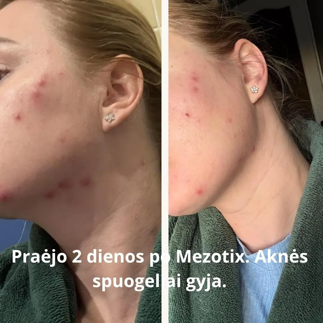Changes in acne healing