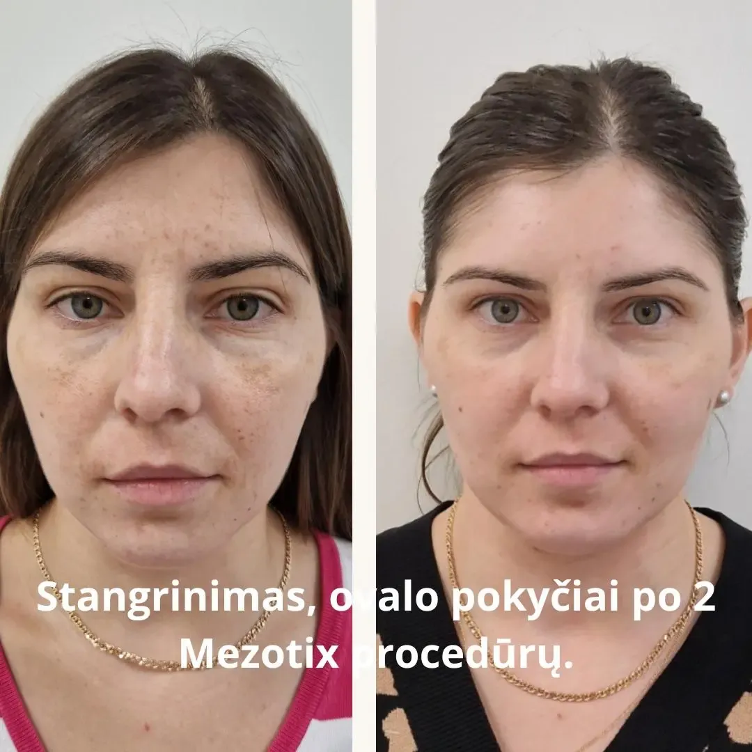 Skin firmness and facial contour