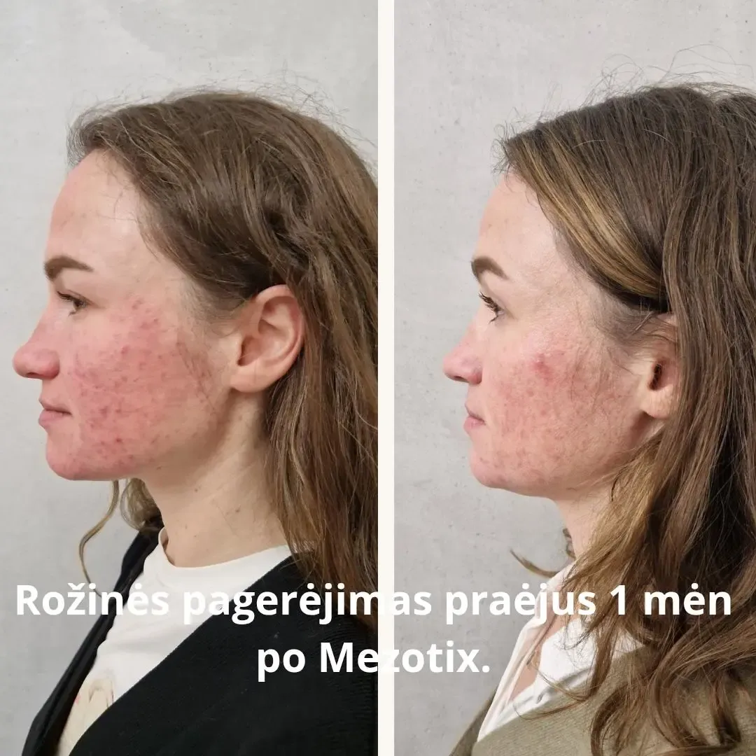 Improvement in the appearance of rosacea
